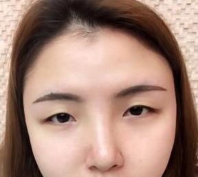 双眼皮案例分享 浙江妹子双眼皮案例-自然款双眼皮
