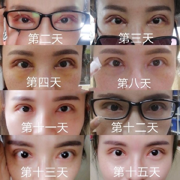 南京康美整形陈小剑医生全切双眼皮修复
