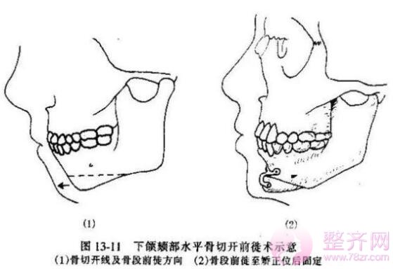 脸型太短怎么办?假体隆下巴没问题吗?
