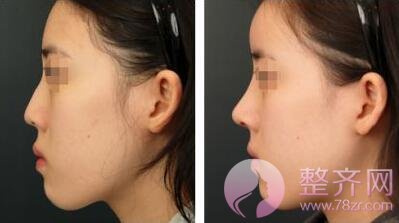 为什么好多网红隆鼻后变成猪鼻子?