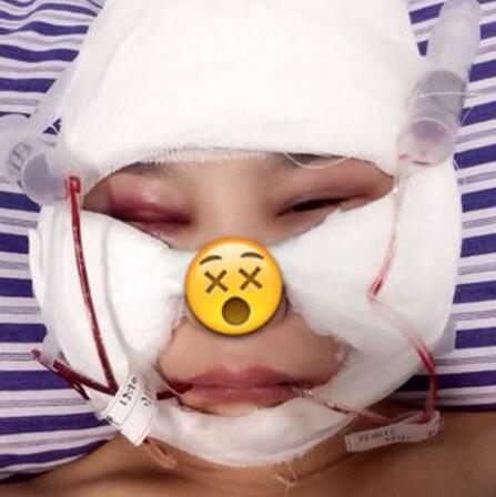 磨骨案例对比图 瘦脸改脸型,V脸磨骨案例分享