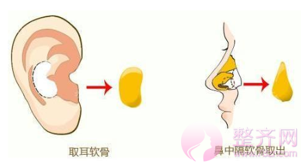 为什么鼻部手术能让鼻子变得如此精致?