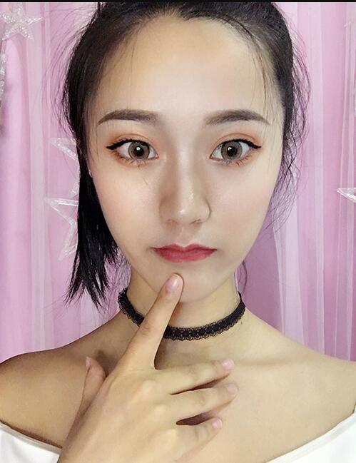 重庆美圣美邦医疗美容做的鼻部手术(自体脂肪填