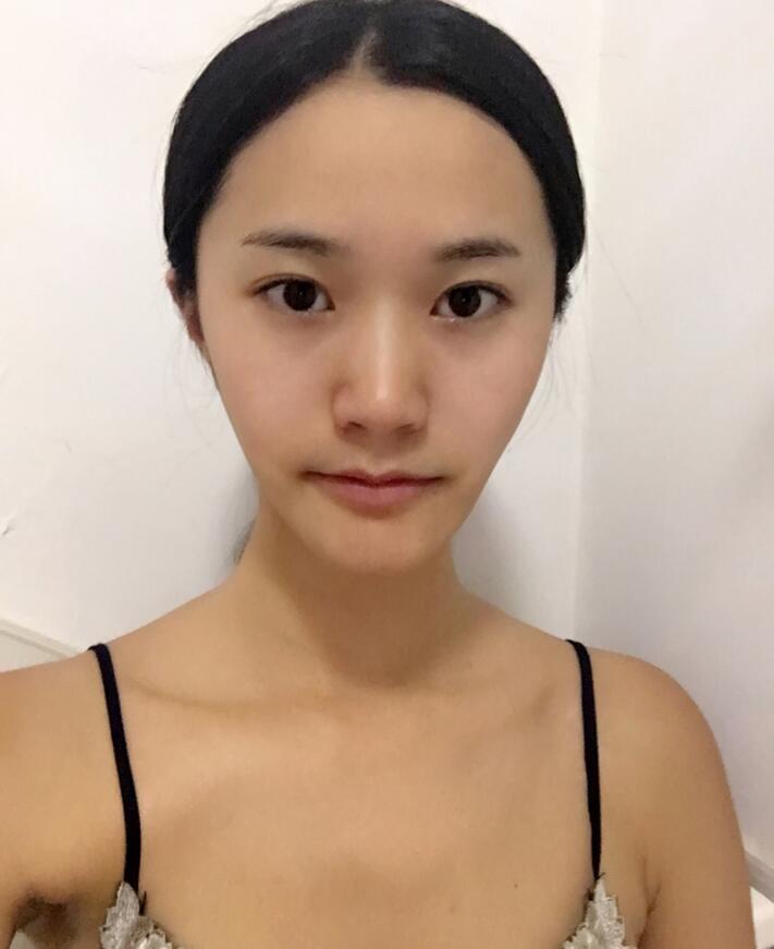 重庆美圣美邦医疗美容做的鼻部手术(自体脂肪填