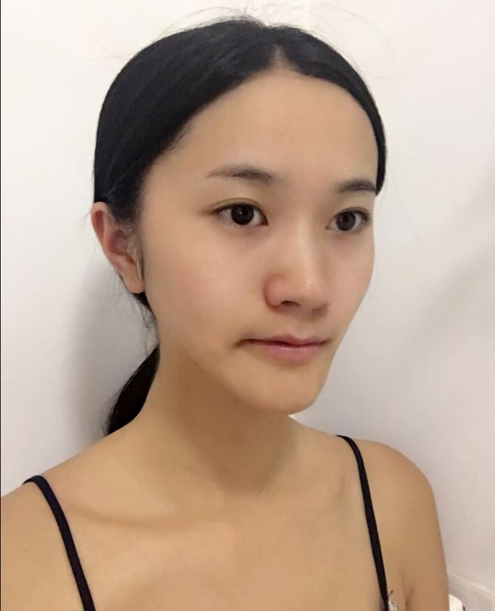 重庆美圣美邦医疗美容做的鼻部手术(自体脂肪填