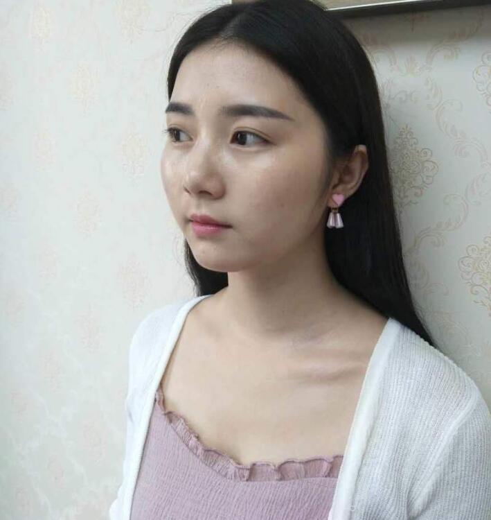 成都医美整形刘国权医生做的膨体下巴案例