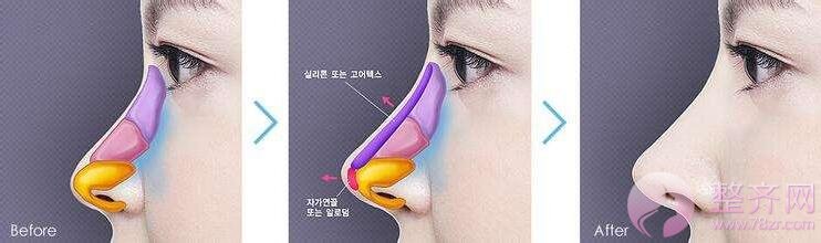 隆鼻后确实好看,但老了怎么办?