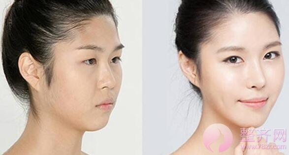 隆鼻后确实好看,但老了怎么办?