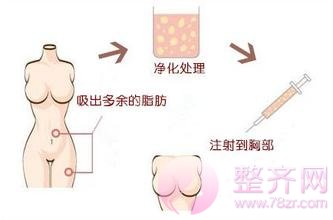 自体脂肪丰胸有疤痕吗?