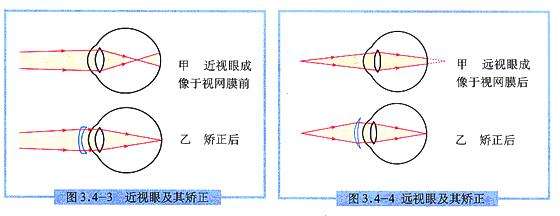 近视眼戴眼镜会让眼球变突出吗?
