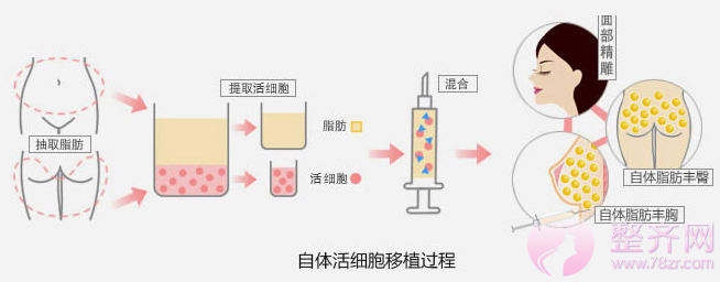 做面部填充,自体脂肪与玻尿酸哪个更好?