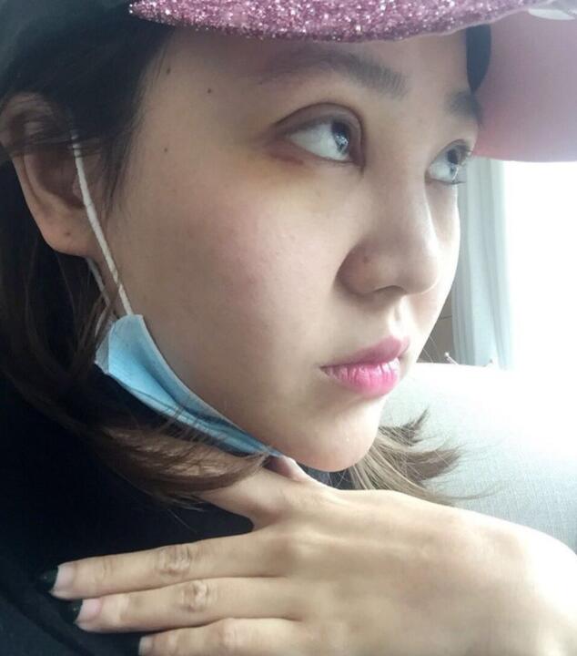 重庆晶肤医疗美容医院做的埋线双眼皮案例