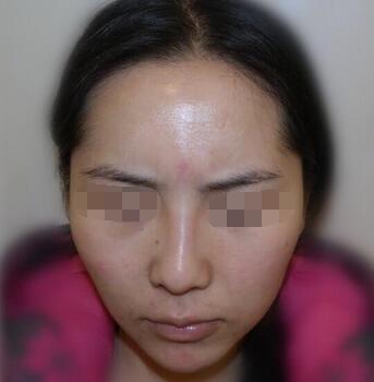 奥美定取出 奥美定取出难吗?奥美定取出案例