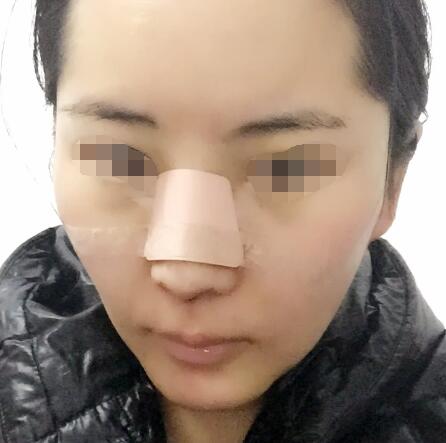 奥美定取出 奥美定取出难吗?奥美定取出案例