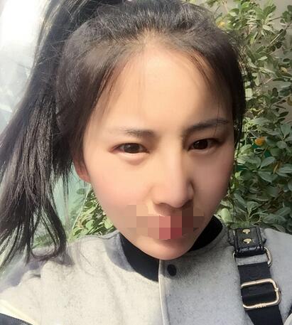 奥美定取出难吗?奥美定取出案例