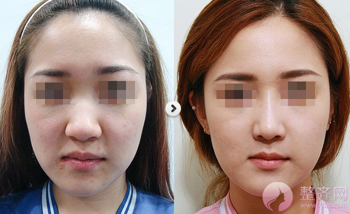 【这些人需要做鼻翼缩小手术,看看有你吗】