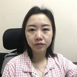 深圳蒳美迩医疗美容鼻部手术(耳软骨硅胶隆鼻)