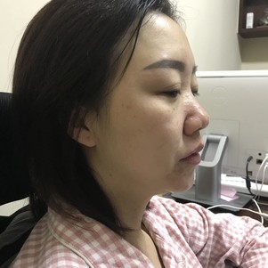 深圳蒳美迩医疗美容鼻部手术(耳软骨硅胶隆鼻)