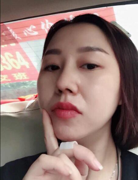 深圳蒳美迩医疗美容鼻部手术(耳软骨硅胶隆鼻)