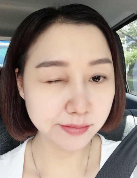 深圳蒳美迩医疗美容鼻部手术(耳软骨硅胶隆鼻)