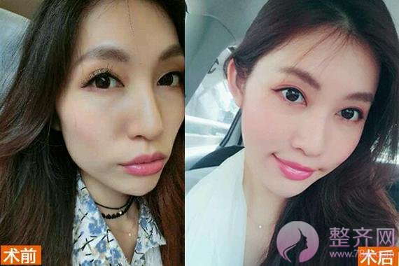 如何有提高脂肪成活率?
