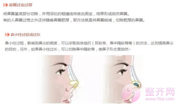 如何拥有一个精致的鼻子?
