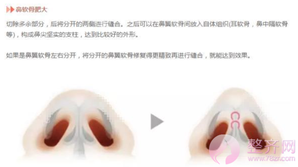 如何拥有一个精致的鼻子?