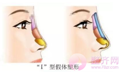 如何拥有一个精致的鼻子?