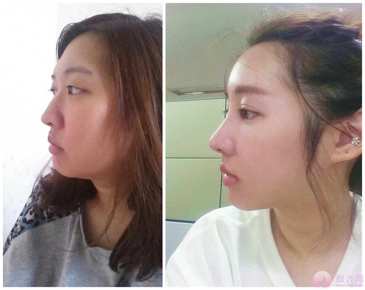 玻尿酸VS隆鼻,到底要怎么选