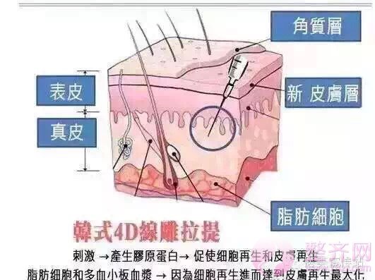 埋线提拉到底有什么作用?