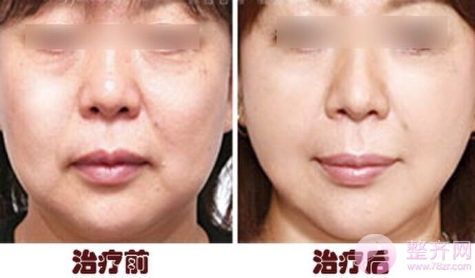 面部饱满,其实就是这么简单!