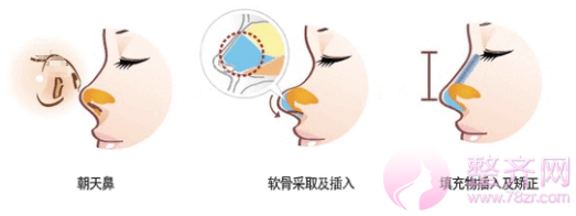 蒜头鼻与朝天鼻的区别你知道吗?