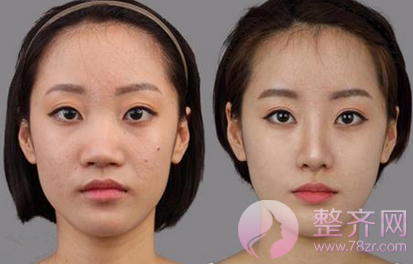蒜头鼻与朝天鼻的区别你知道吗?