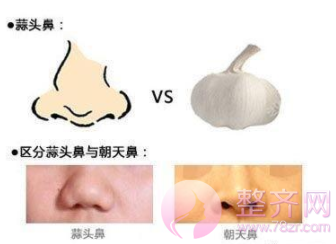 蒜头鼻与朝天鼻的区别你知道吗?