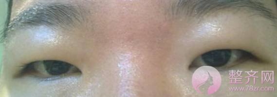 肿泡眼去脂后眼皮还是厚,是手术失败了吗?