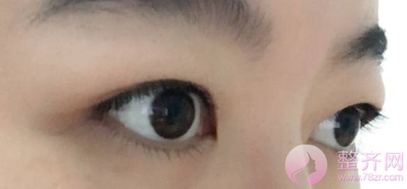 肿泡眼去脂后眼皮还是厚,是手术失败了吗?