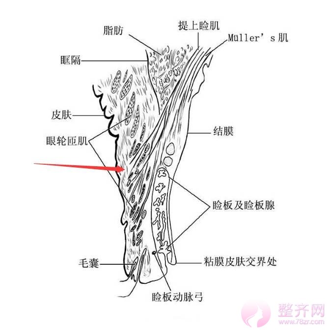 肿泡眼去脂后眼皮还是厚,是手术失败了吗?