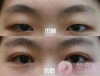 肿泡眼去脂后眼皮还是厚,是手术失败了吗?