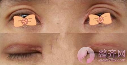 肿泡眼去脂后眼皮还是厚,是手术失败了吗?