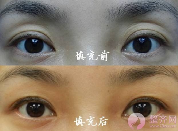 肿泡眼去脂后眼皮还是厚,是手术失败了吗?
