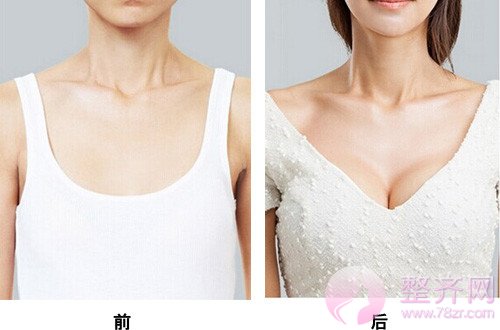 隆胸后的四种结果 你知道吗?