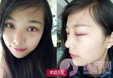 不知道这些眼部整形知识你敢去割双眼皮吗?