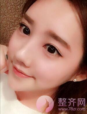 为什么需要做自体脂肪填充?