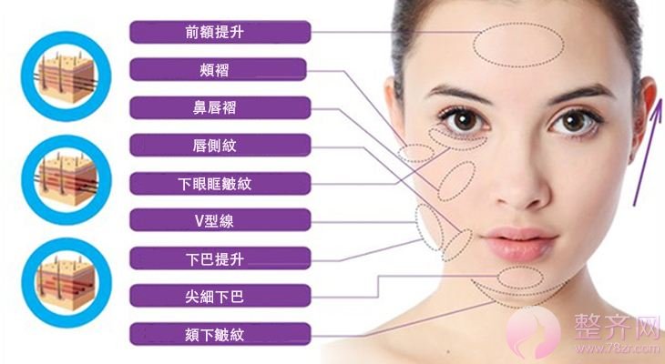 埋线提升术后出现凹陷,断线,该怎么办?
