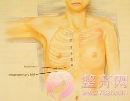自体肋软骨鼻整形手术,肋软骨选左侧还是右侧