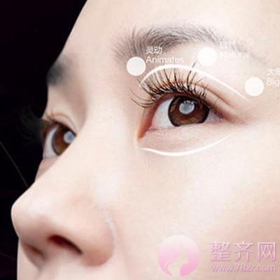 全切双眼皮较稳定有的手术方式