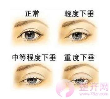 全切双眼皮较稳定有的手术方式