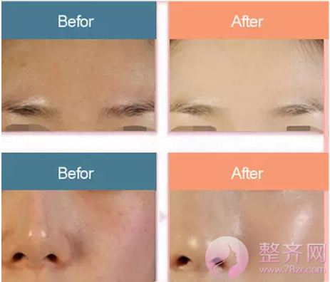 水光补水的作用以及注意事项有哪些?