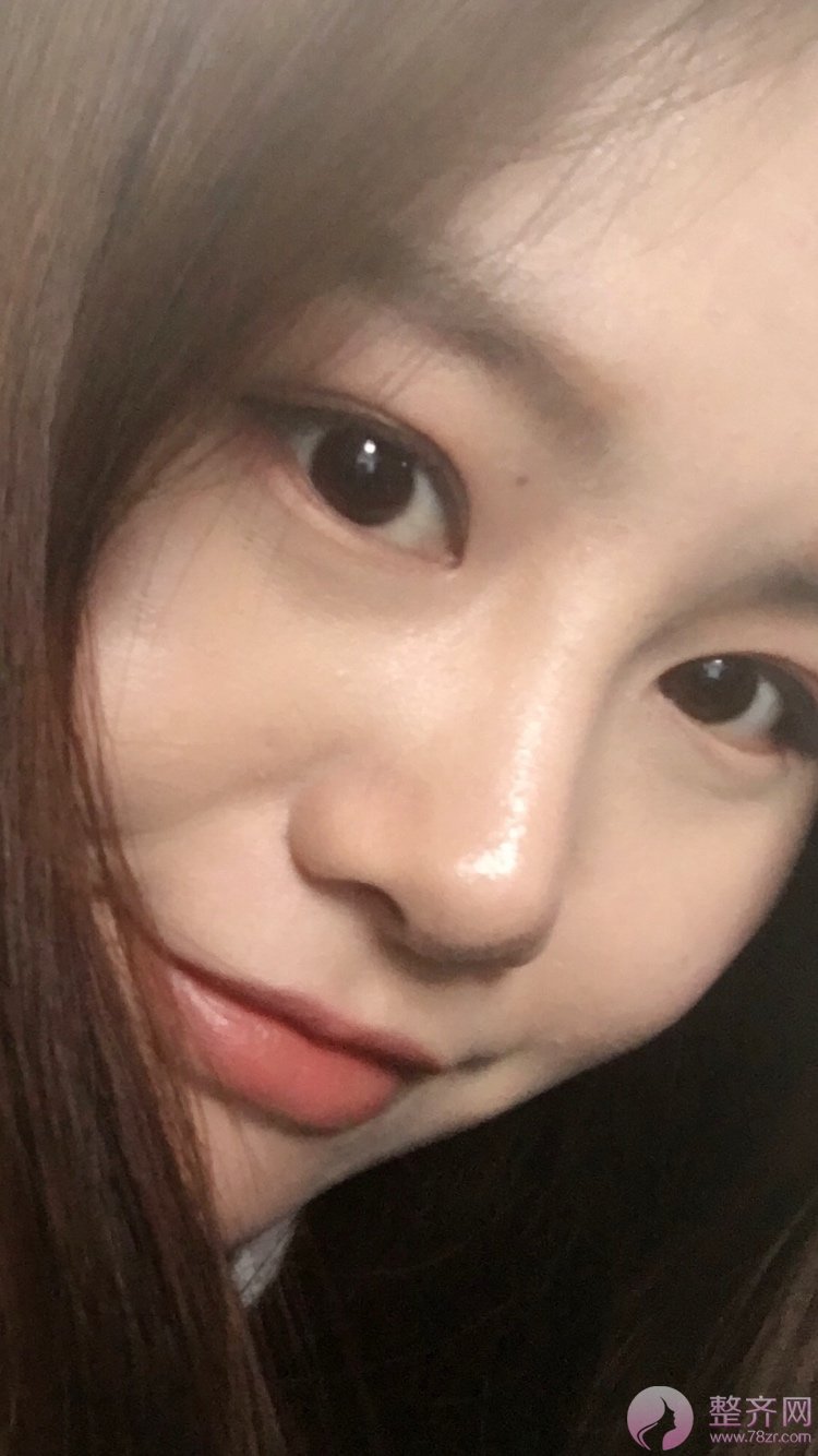 自体脂肪填泪沟恢复期是多久?