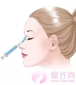 影响隆鼻果的四个因素